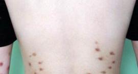 WT: Evaluation of pruritus WT: Evaluation of pruritus